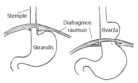 Fundoplikacija Gastroezofaginio Refliukso Liga Gerl Ir Jos Gydymas