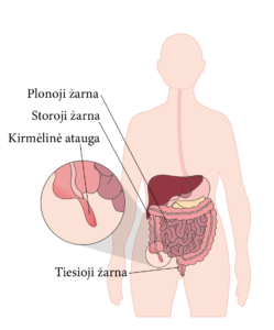 Apendektomija Pilvo chirurgijos operacijos